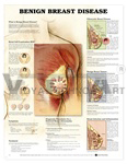 Benign Breast Disease Anatomical Chart